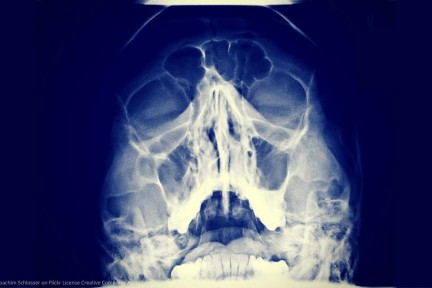 Gesicht Nase Röntgen